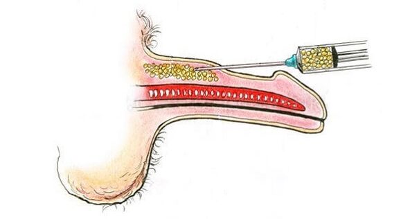 Zastrzyki kwasu hialuronowego do lufy członka, aby